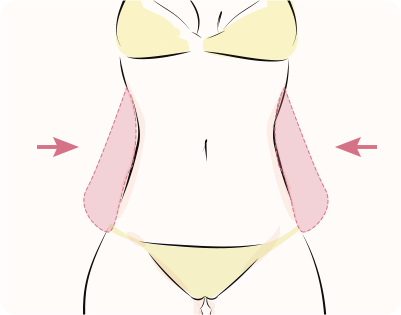 脂肪吸引（腹部）（スタンダード）